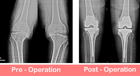 Bilateral-Total-Knee-Replacement