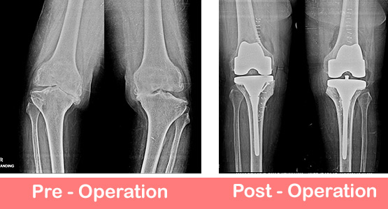 Bilateral Total Knee Replacement