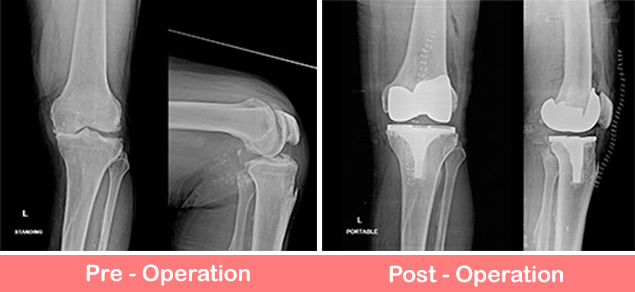 Pawan-Suri-Left-Knee- Replacement