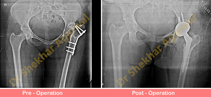Primary Complex Total Hip Replacement