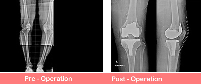 anita-kumar-left-total-knee-replacement