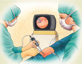 arthroscopy-of-knee