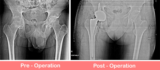 Primary Complex Total Hip Replacement