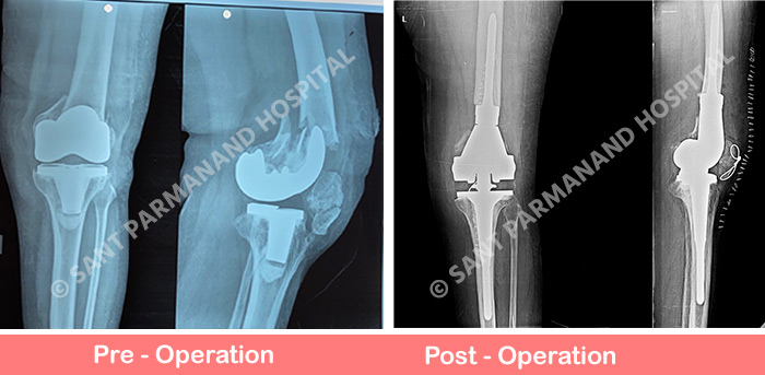 Revision Total Knee Replacement