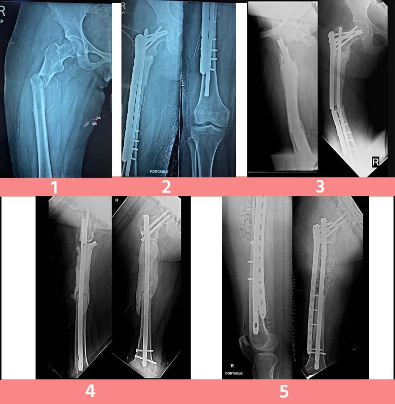 Complex Fracture Fixation with Large Bone Defect