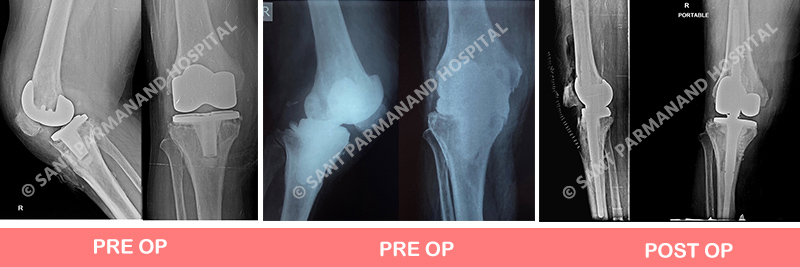 Revision Total Knee Replacement