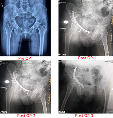 Complex Supramajor Pelvi-Acetabular Surgeries