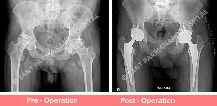 Bilateral Total Hip Replacement