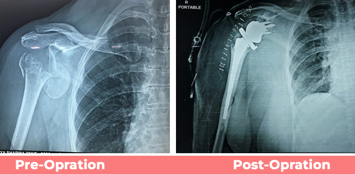 Reverse Total Shoulder Replacement