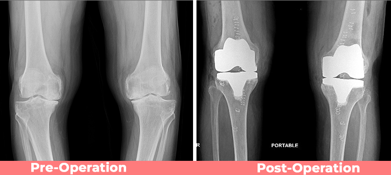 ROBOTIC KNEE REPLACEMENT SURGERY