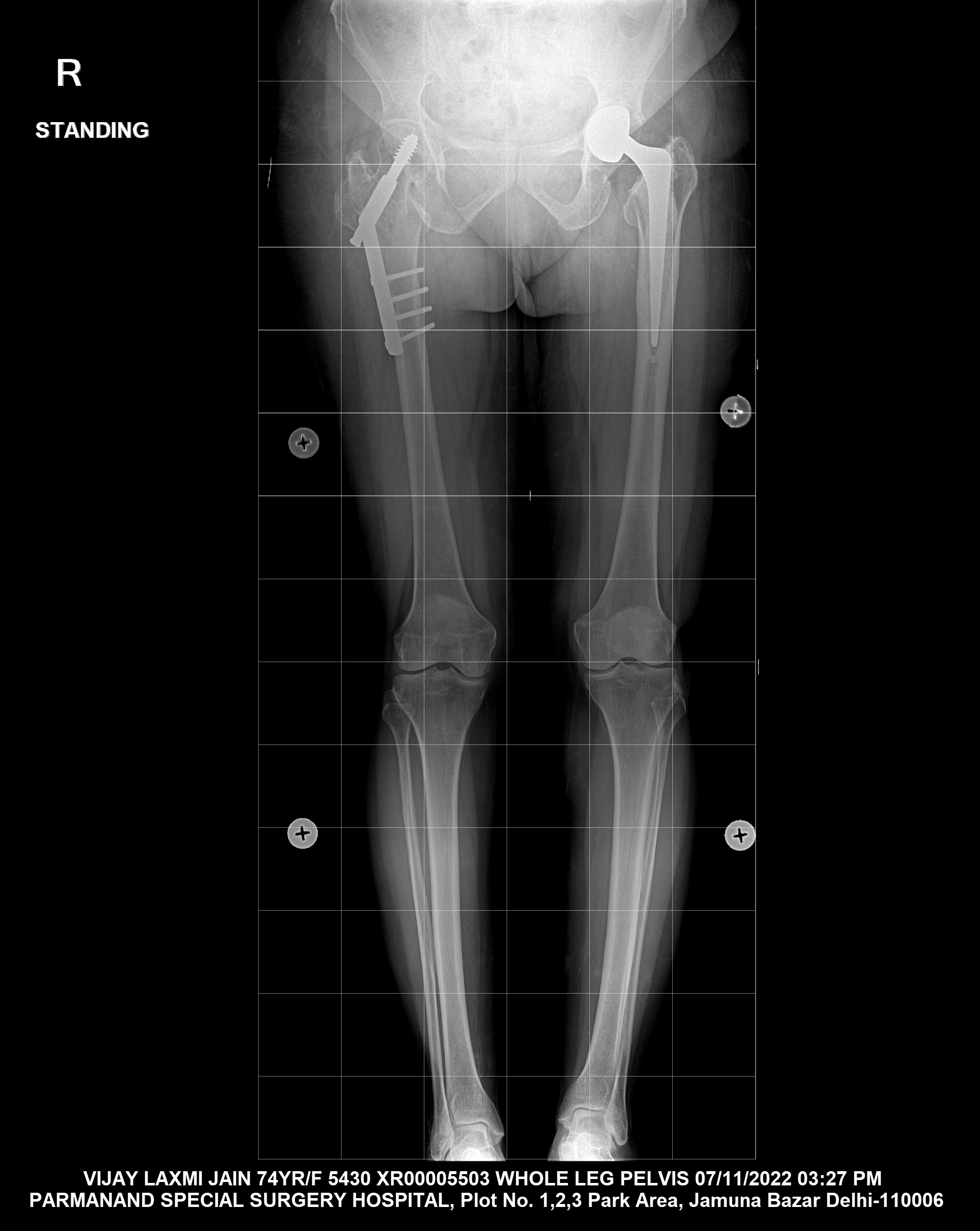 Total hip replacement, Radiology Case