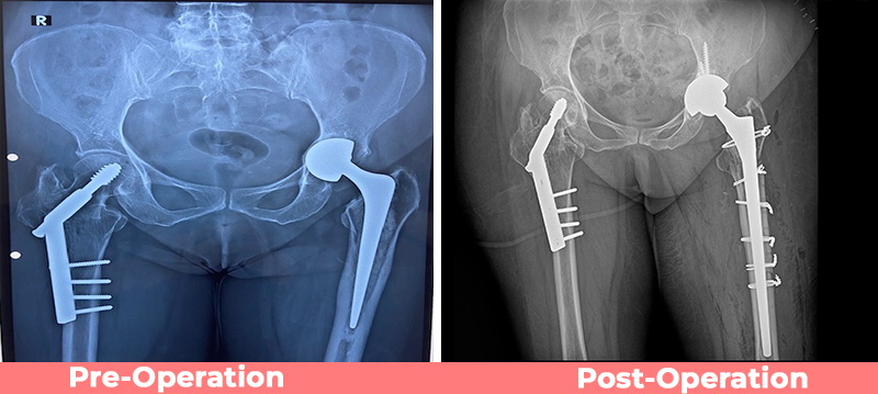 Revision Complex Total Hip Replacement Delhi Institute Of Trauma