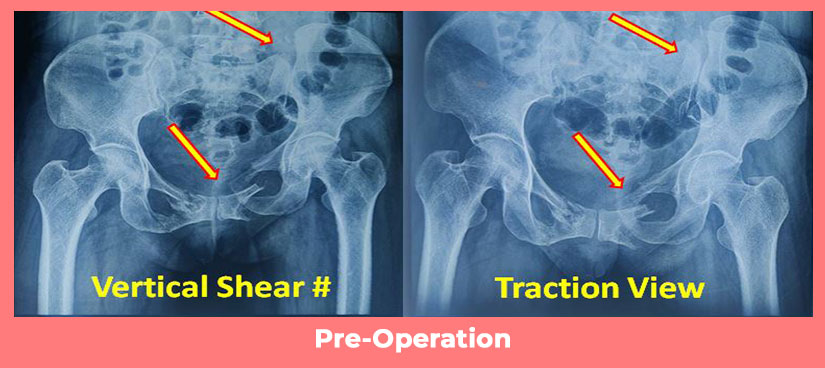 Complex Pelvic -Acetabular Injury