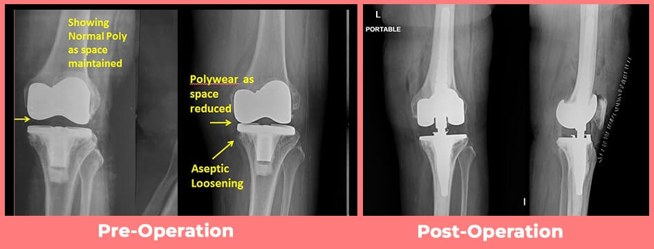 Revision Knee Replacement surgery width=
