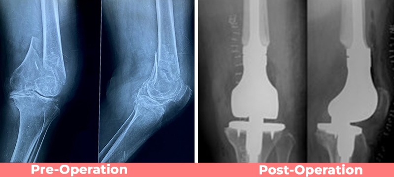 Distal Femur Replacement 
